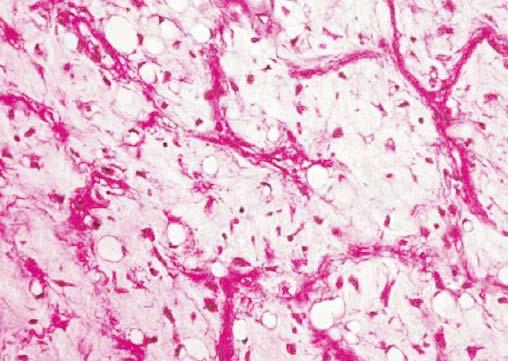 29 Figure 6. Microscopic image - Myxoid fibrosarcoma HE Figure 9. Tumour adherent to inferior vena cava - Case 2 Figure 7.