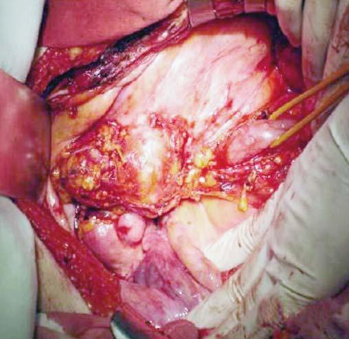 Dissection and isolation of compressed ureter due to tumoral mass Case 3 allergic reaction and it did not reveal any hypophysis, adrenal or thoracic abnormalities.