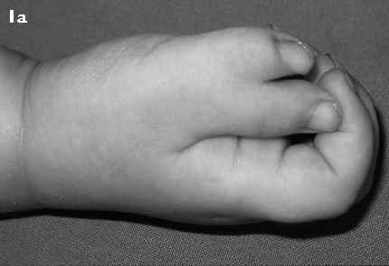 Pictorial Essay Singapore Med J 2010, 51(12) 965 CME Article Common congenital hand conditions Chong A K S ABSTRACT Congenital hand deformities are common but most of these conditions are minor.