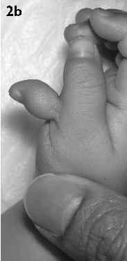 thumb duplication with a soft tissue stalk attached to the main