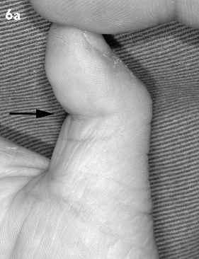 (b) The flexor tendon sheath is approached through a cosmetic skin crease incision at the base of the thumb.
