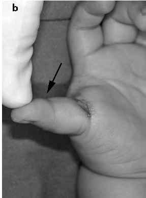 (a) The characteristic position of the trigger thumb is a flexed position of the thumb interphalangeal joint (arrow).