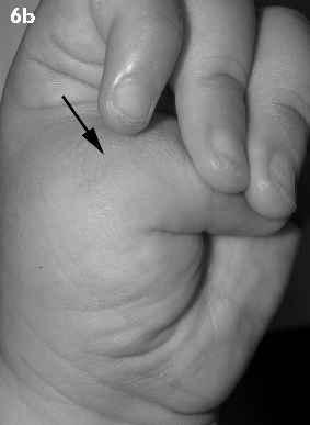 The metacarpophalangeal joint is held flexed (arrow), and the interphalangeal joint is not affected. However, the thumb, including the metacarpophalangeal joint, can usually be passively extended.