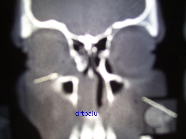 Lacrimal drainage system: Inflammation involving lacrimal drainage system leads to: Tearing Anterior orbital / lid swelling Rarely upward & lateral displacement of orbit Presence of fistula CT scan