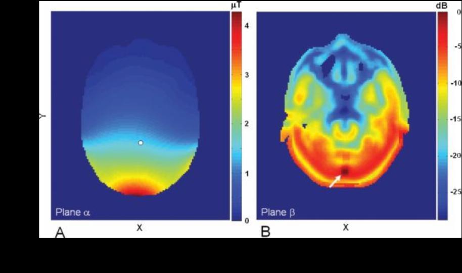 In vivo 13C magnetic resonance spectroscopy of human brain on a clinical 3 T scanner using [2-13C]glucose infusion and low-power stochastic decoupling.