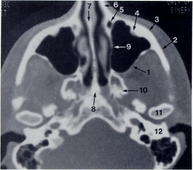 Dolan et al. Facial fractures C.