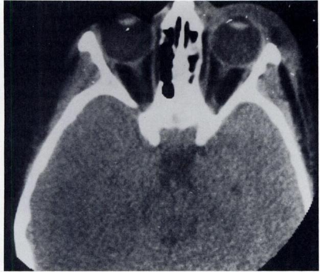 Dolan et al. Facial fractures III Radiological Signs of Facial Injury A. SUGGESTIVE SIGNS 1.