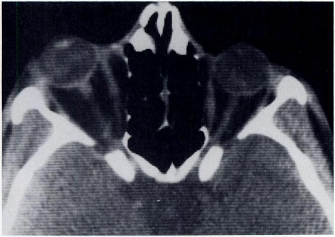 On facial radiographs, one may detect the hematoma produced at a contact point; the soft tissue opacity should signal the possibility of an underlying fracture.