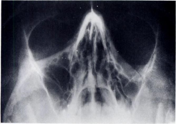 In such patients, air escapes from the maxillary sinus when the patient blows his nose.