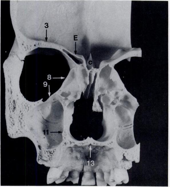 plate lies between these structures. Inflammatory mucous membrane thickening partly opacifies the right maxillary sinus.