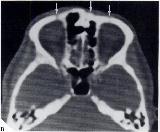 A fracture of the anterior surface of the frontal sinus is well defined in Figure 3bA.