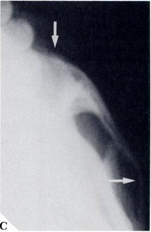 Figure 35B, an underexposed basal view, clearly shows outward (lateral) bending of the zygomatic arch; it also demonstrates posterior displacement of the body of the zygoma.