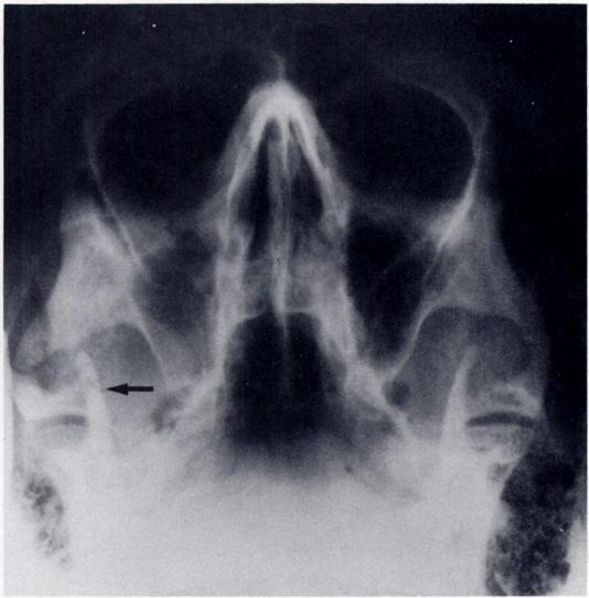 The patient whose radiograph is seen in Figure 37, for example, was struck when his mouth was closed. The zygoma impinged on the coronoid process, and the patient could not open his mouth.