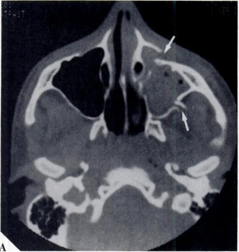 Facial fractures Dolan et al. E. ORBITAL APEX AND OPTIC CANAL INJURY COMPLICATING THE TRIPOD FRACTURE A CT study of a similar injury is illustrated by Figure 46.