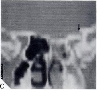 A coronal CT reconstruction shows how the border of the superior fissure formed by the greaten wing of the sphenoid has been displaced upward above the level of the lesser wing (Figure 46C).