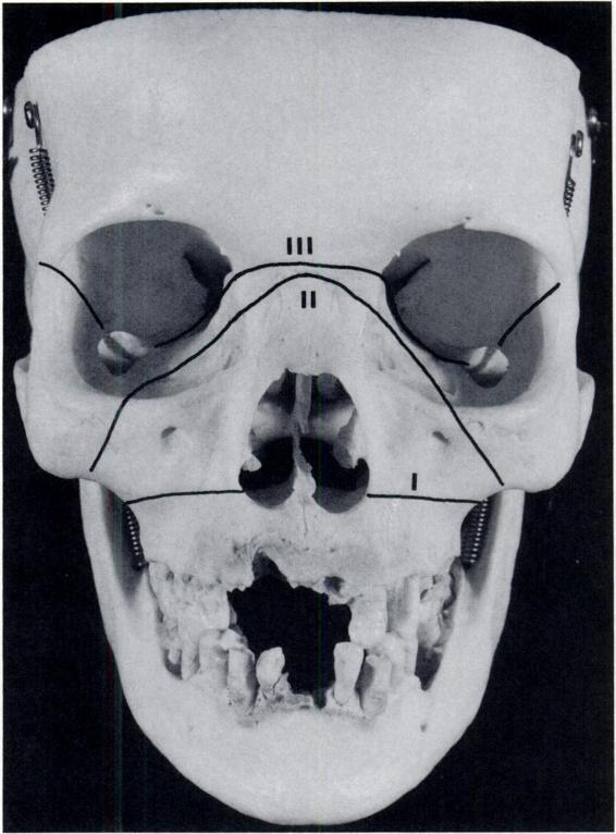 Facial fractures Dolan et al. VI Complex Fractures Complex facial injuries are either bilateral on imply severe comminution of several parts of the facial bone complex.