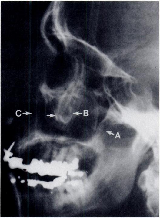 Facial fractures Dolan et al. A. THE LeFORT I FRACTURE The LeFont I plane of weakness traverses both medial and lateral walls of the maxillary sinuses.