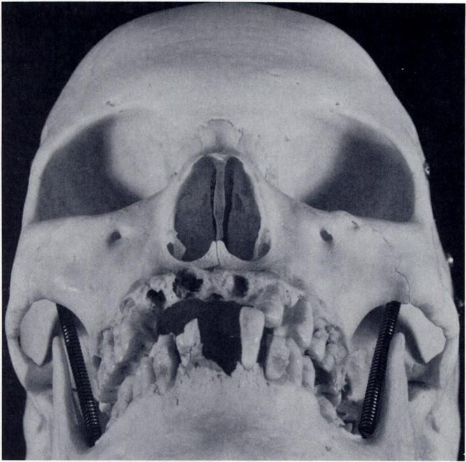 Dolan et al. Facial fractures B.