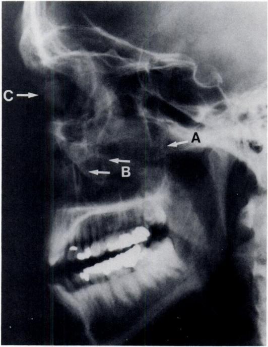 Facial fractures Dolan et al. B. THE LeFORT II FRACTURE The LeFont II fracture illustrated by Figure 50A has interrupted the pterygomaxillary contices.