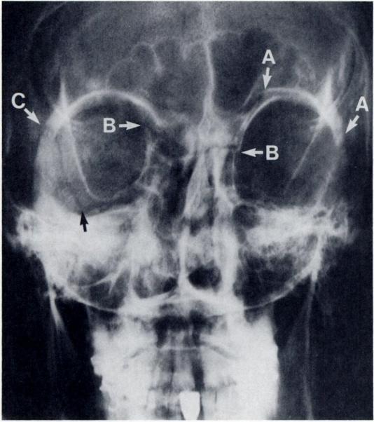 fracture (arrowhead). There is a pterygoid process fracture indicated by the large arrow.