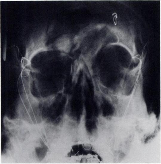 of a fracture involving the antenor wall of the frontal sinus.