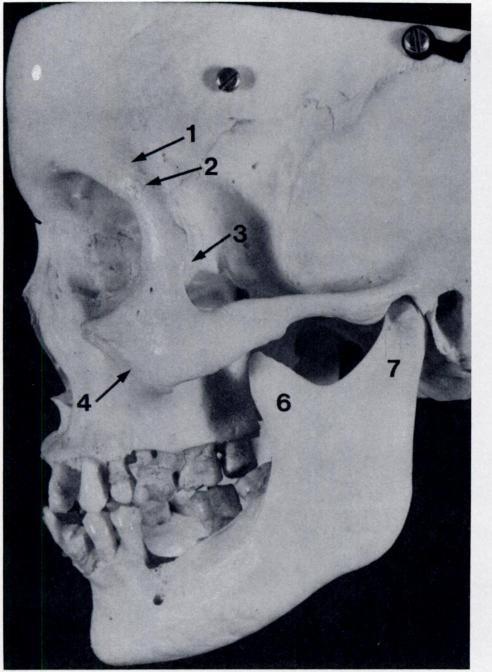 Dolan et al. Facial fractures B. RADIOGRAPHIC ANATOMY Figure 5A A lateral view of a dried skull preparation for comparison with Figure 5B.