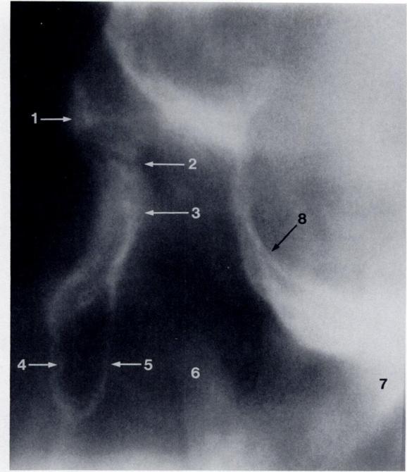 Frontal process of orbit 2. Zygomaticofrontal suture 3. Zygomatic process of orbit 4. Anterior surface of zygomatic recess of maxilla 5.