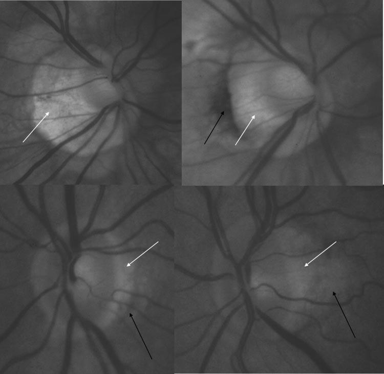 2530 Healey et al. IOVS, June 2007, Vol. 48, No. 6 on the optic nerve were taken of both eyes of all the twins.