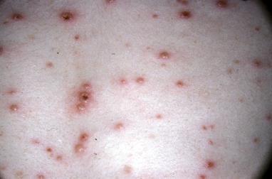Chickenpox(varicella) Vesicular lesions on an erythematous base Appear in crops and are present in different