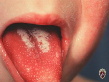 Scarlet fever Exotoxin-mediated diffuse
