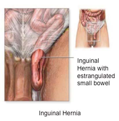 215 4 5 Figures 4-5. These images are used to explain the pathology of the inguinal hernia 6 7 Figures 6-7.
