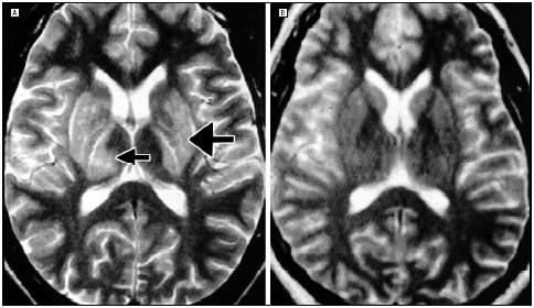 MRI Deposition of Copper in the Basal Ganglia Wilson Normal
