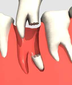 grips debris after extraction During extractions annoying tooth fragments or loose root tips remain attached