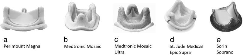 S140 Circulation September 15, 2009 Figure 1. Overview of different complete supraannular bioprostheses. A, Magna; B, Mosaic; C, Ultra; D, Epic; E, Soprano.
