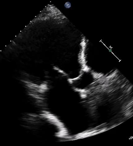 Case 1: 58 yr old male with history of ischemic