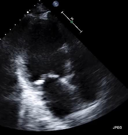 Case 2: 65 yr old male with ischemic
