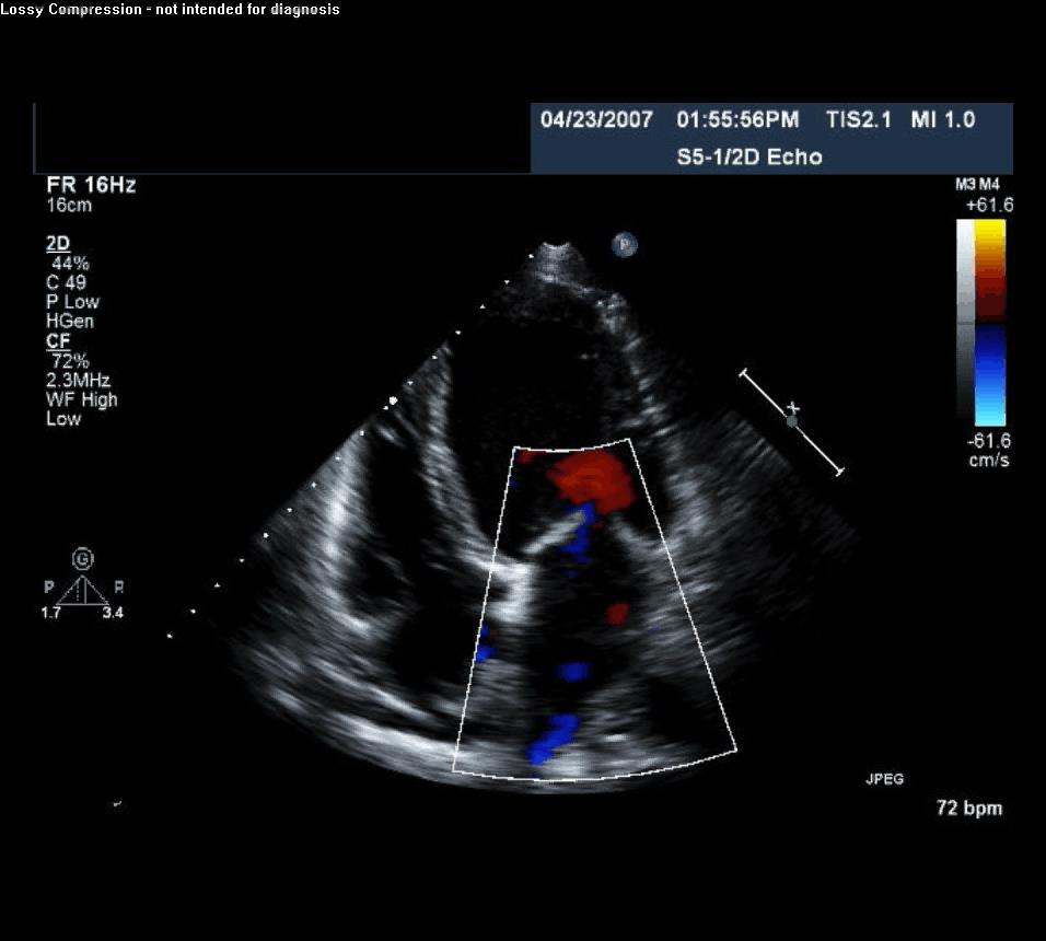 Functional(Secondary) Mitral Regurgitation (FMR) An unmet clinical need Leaflets & chordae have no obvious