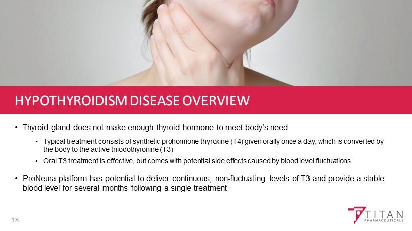 HYPOTHYROIDISM DISEASE OVERVIEW Thyroid gland does not make enough thyroid hormone to meet body s need Typical treatment consists of synthetic prohormone thyroxine (T4) given orally once a day, which