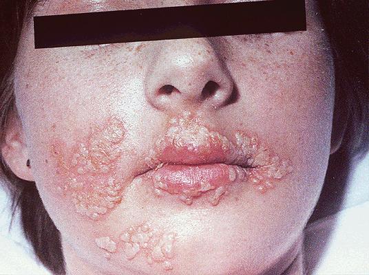HSV-1: primary skin infection in adult patient Herpetic whitlow