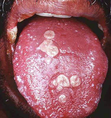 Vesiculopapular changes in the course of recurrent HSV-1 gingivostomatitis Primary infection with HSV-1 severe systemic