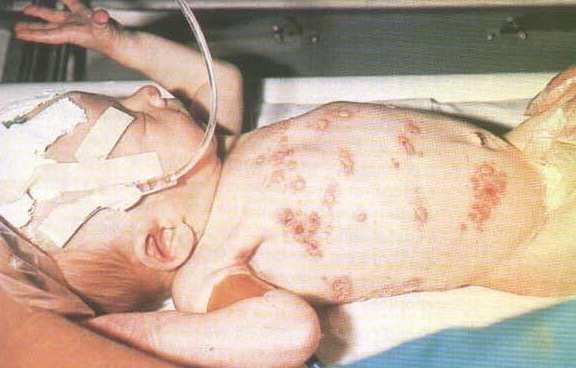 HSV-2 noticeable mortality result of congenital infection or spread from mother during