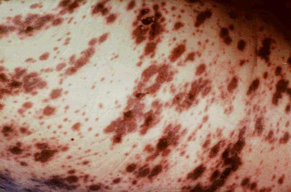 Chickenpox perinatal infections: severe course, risk of complications (pneumonia, meningitis, mortality) haemorrhagic chickenpox: primary infection in elderly patients or in