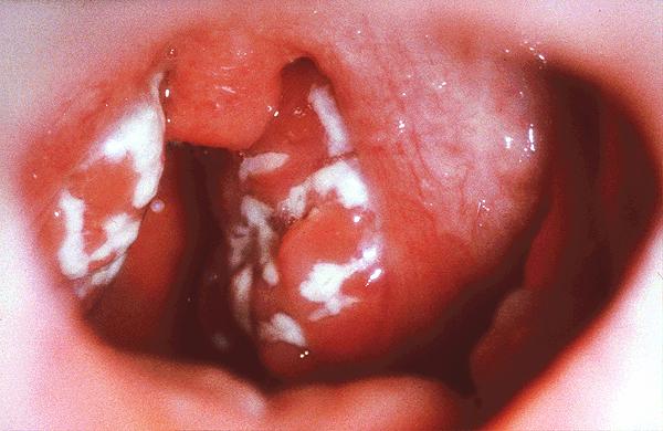 Characteristic lesions on tonsils EBV pathogenicity is correlated with host genetic factors (HLA haplotype) Infectious mononucleosis Europe,