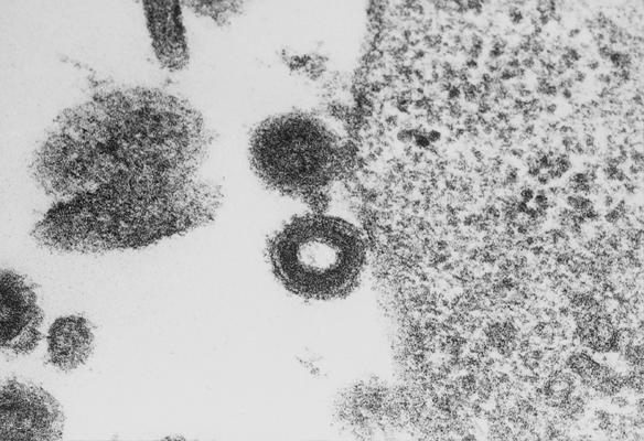 HHV-6 (Human Herpesvirus 6) species A and B Subfamily: