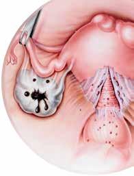 Endometriosis From Identification to Management Endometriosis, a gynecologic disorder that typically affects women of childbearing age, can result in dysmenorrhea, deep dyspareunia, chronic pelvic