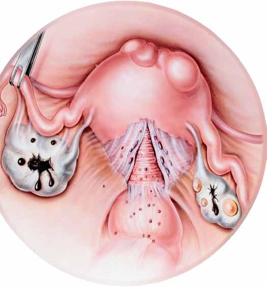 Endometrioma Punctate foci Adhesion FIGURE Of unknown cause, endometriosis the displacement of endometrial tissue outside the uterus results in lesions, usually found on the ovaries, fallopian tubes,