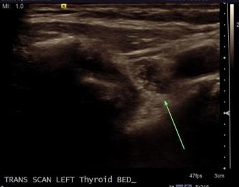 thyroid fossa region. The lesion shows few tiny punctate foci.