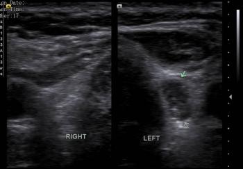 Imaging Technique: Ultrasound; Ultrasound neck showing a heterogenous hypoechoic area measuring 21x9 mm located in the
