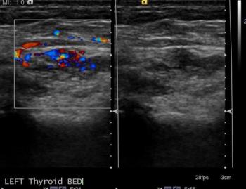 Ultrasound neck with colour Doppler showing heterogenous and chaotic vascularity in the hypoechoic area located in the left