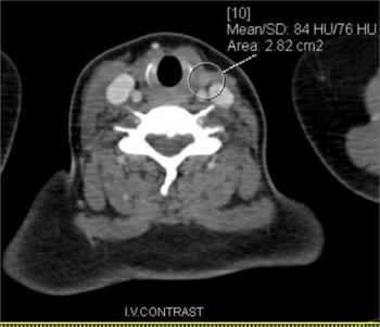 CECT Neck : 2 yrs post surgery Axial post contrast images showing a small 7x5mm enhancing nodule in the left